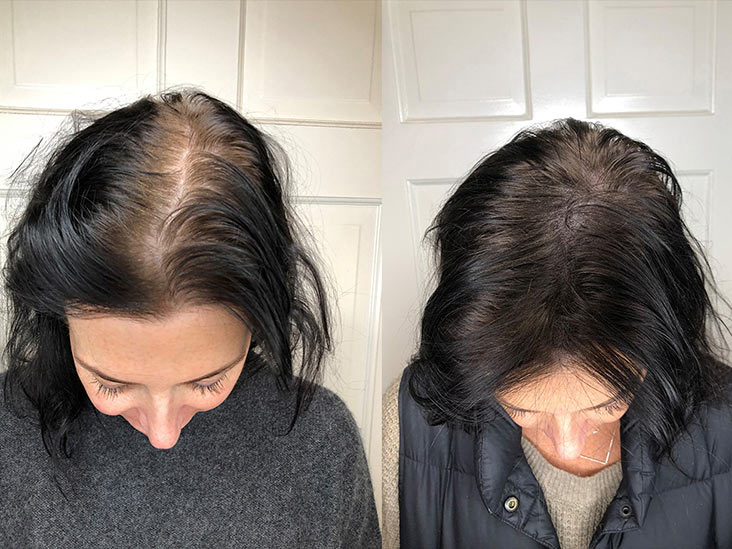 What age does hair start thinning? – Hair Care Science website